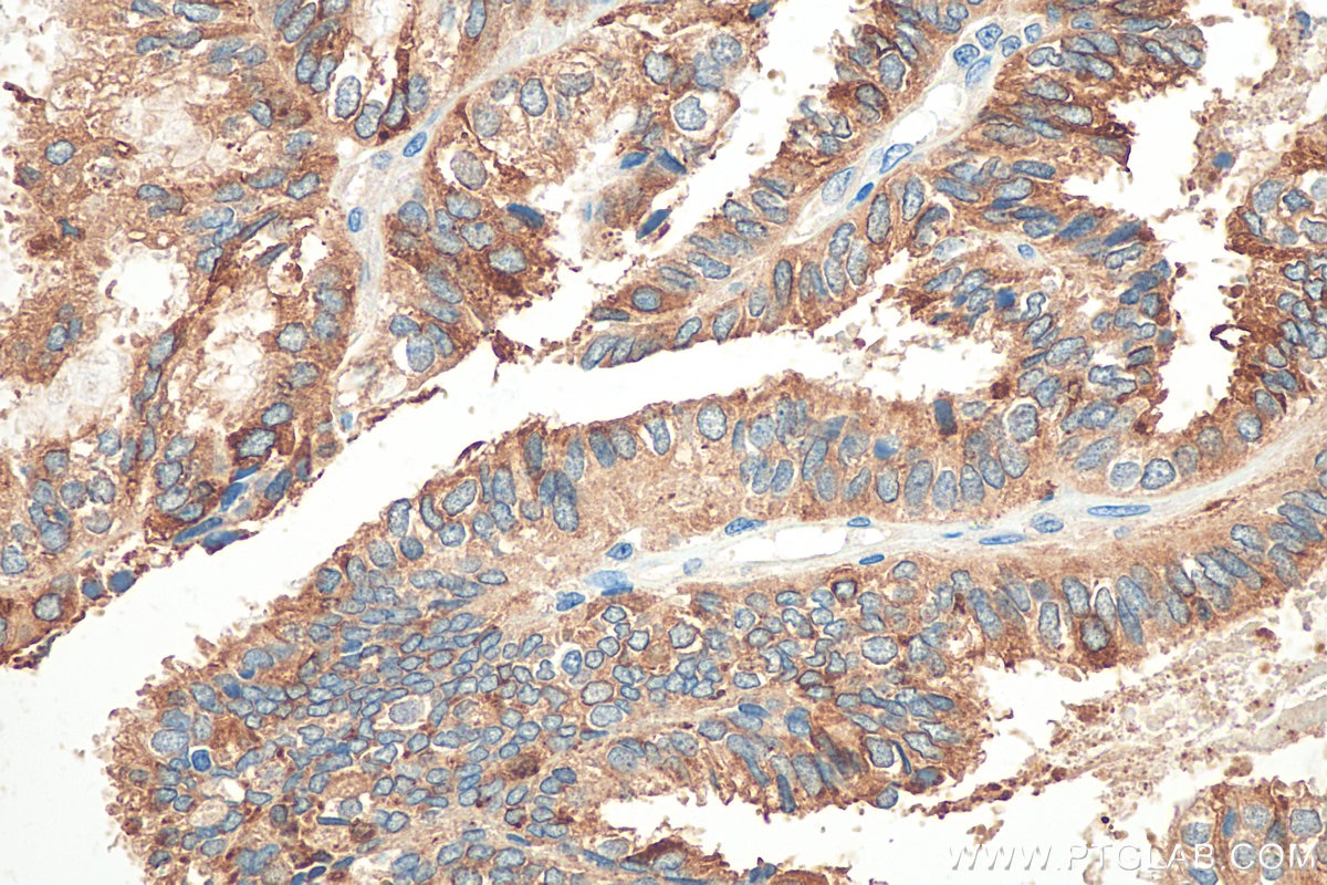 Immunohistochemistry (IHC) staining of human ovary tumor tissue using Mammaglobin B Polyclonal antibody (21211-1-AP)