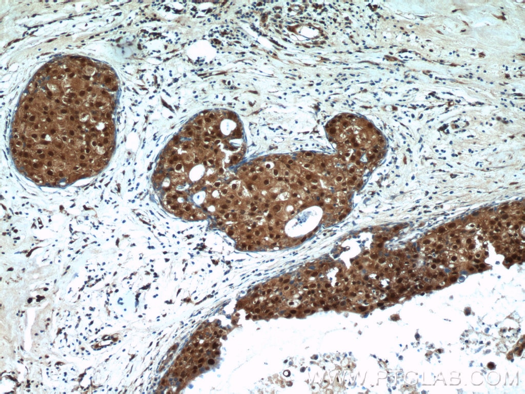 Immunohistochemistry (IHC) staining of human breast cancer tissue using MCL1L-specific Polyclonal antibody (15825-1-AP)