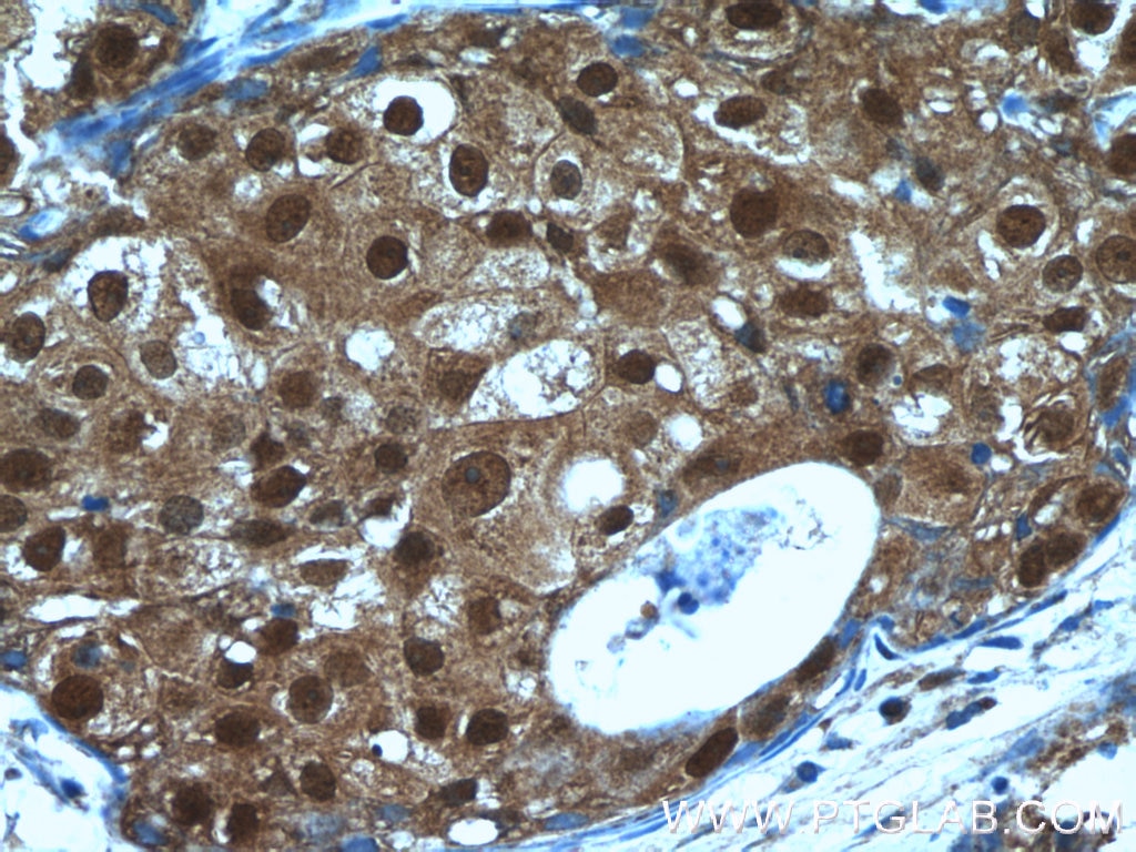Immunohistochemistry (IHC) staining of human breast cancer tissue using MCL1L-specific Polyclonal antibody (15825-1-AP)