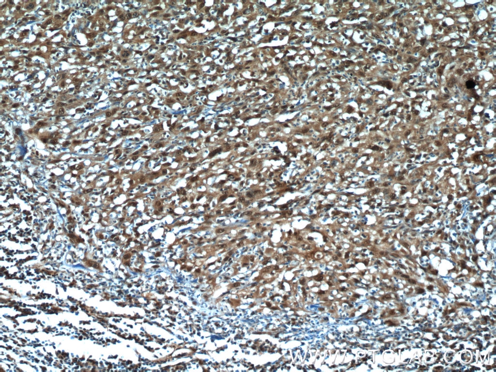 Immunohistochemistry (IHC) staining of human cervical cancer tissue using MCL1L-specific Polyclonal antibody (15825-1-AP)