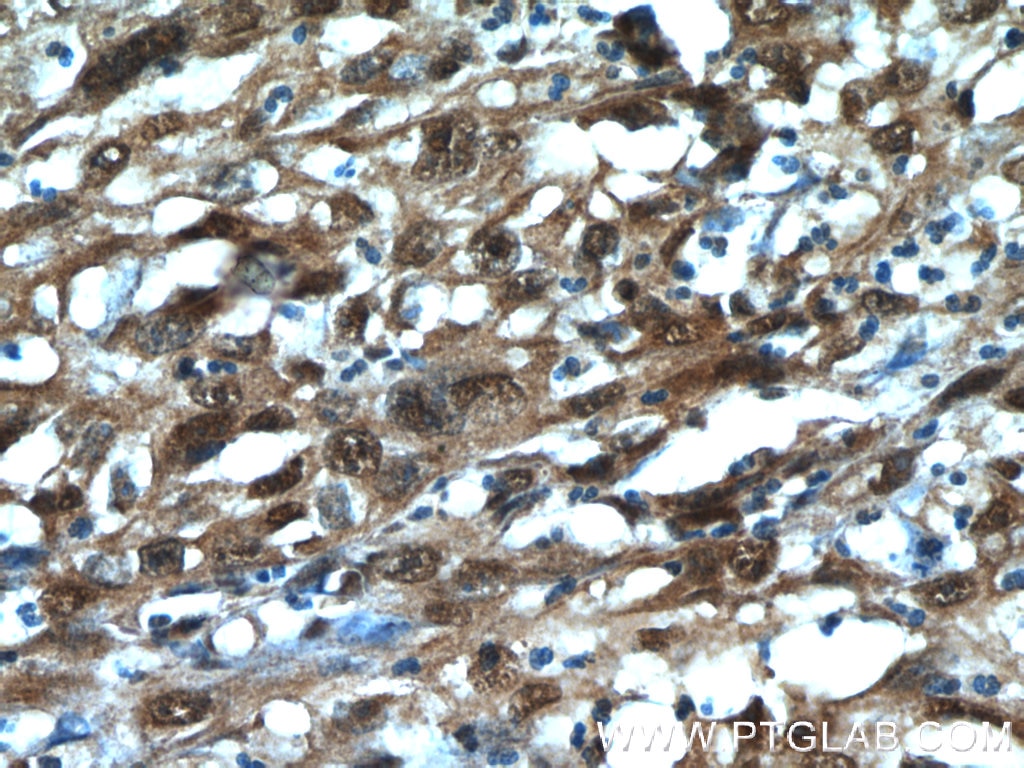 Immunohistochemistry (IHC) staining of human cervical cancer tissue using MCL1L-specific Polyclonal antibody (15825-1-AP)