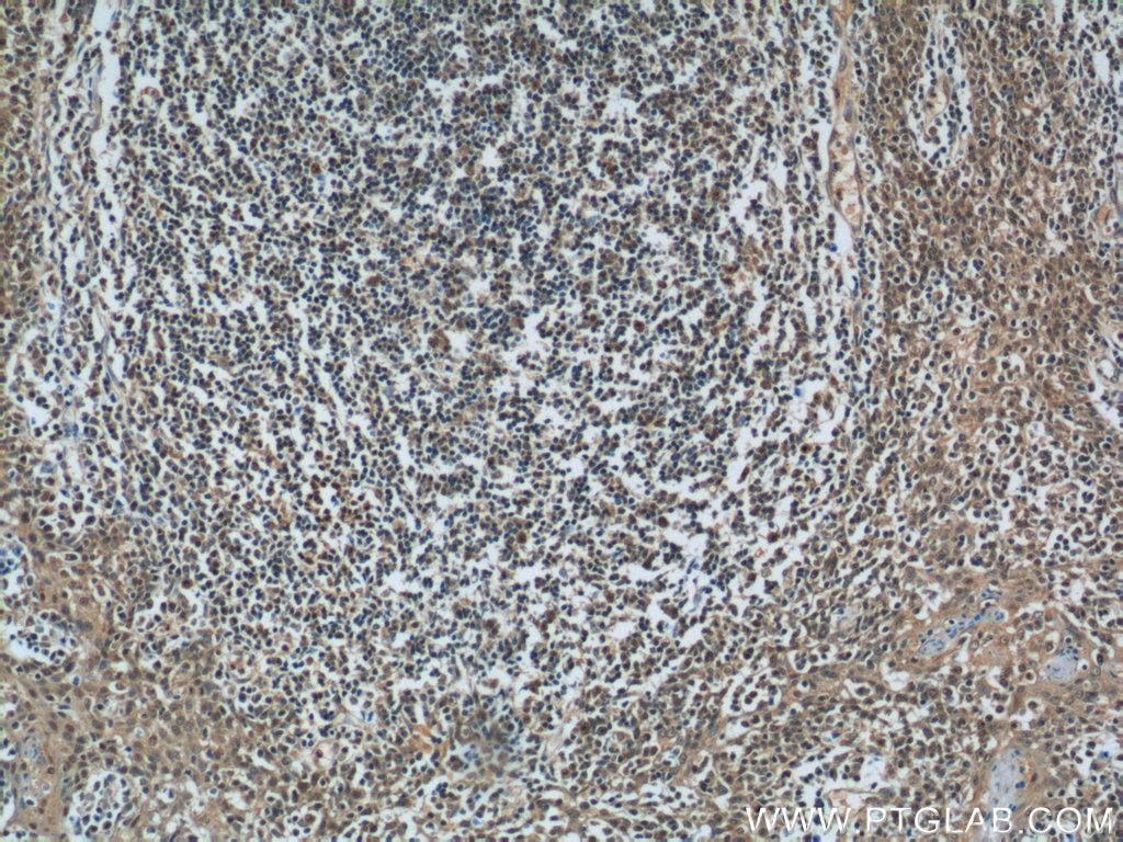 Immunohistochemistry (IHC) staining of human tonsillitis tissue using MCL1L-specific Polyclonal antibody (15825-1-AP)