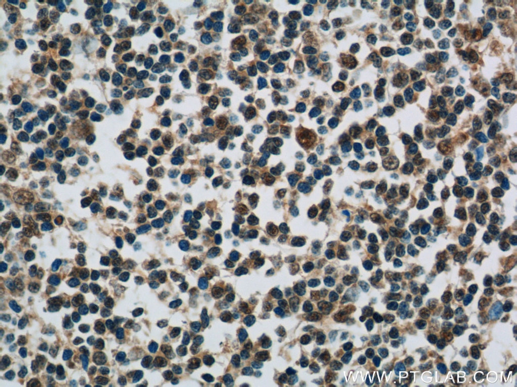 Immunohistochemistry (IHC) staining of human tonsillitis tissue using MCL1L-specific Polyclonal antibody (15825-1-AP)