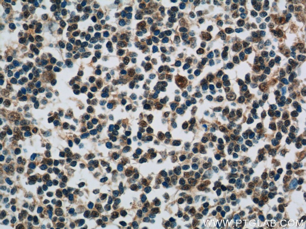 IHC staining of human tonsillitis using 15825-1-AP