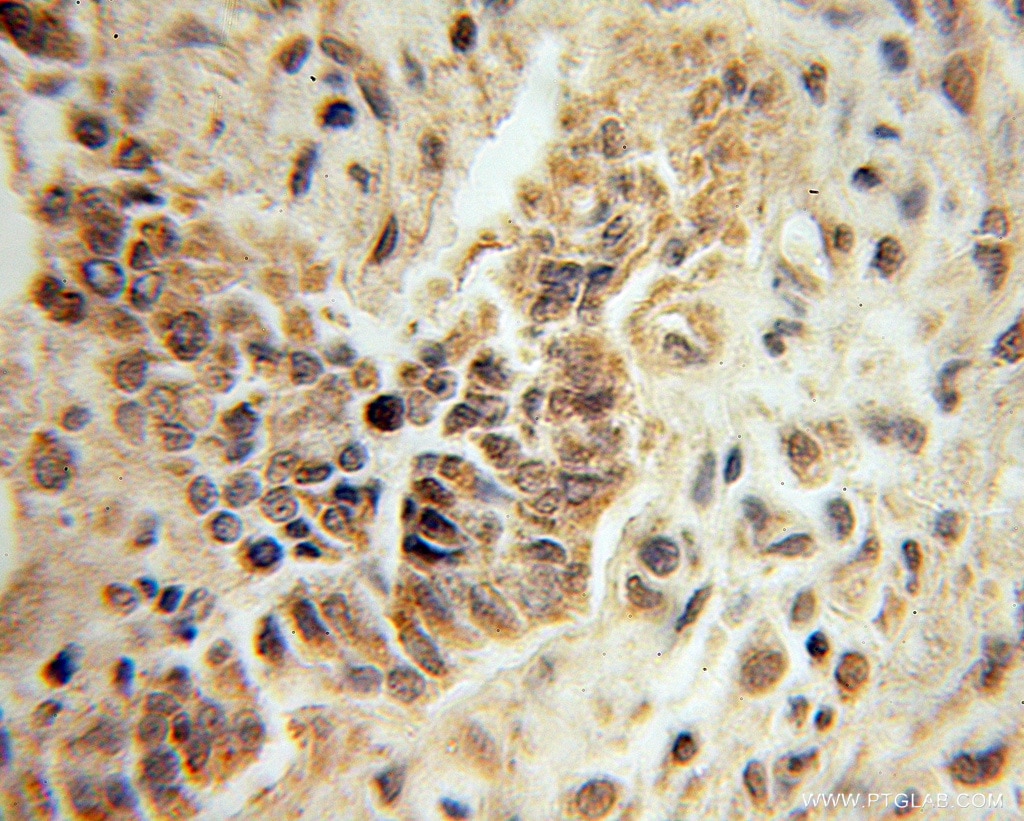 Immunohistochemistry (IHC) staining of human ovary tumor tissue using Mecr Polyclonal antibody (51027-2-AP)