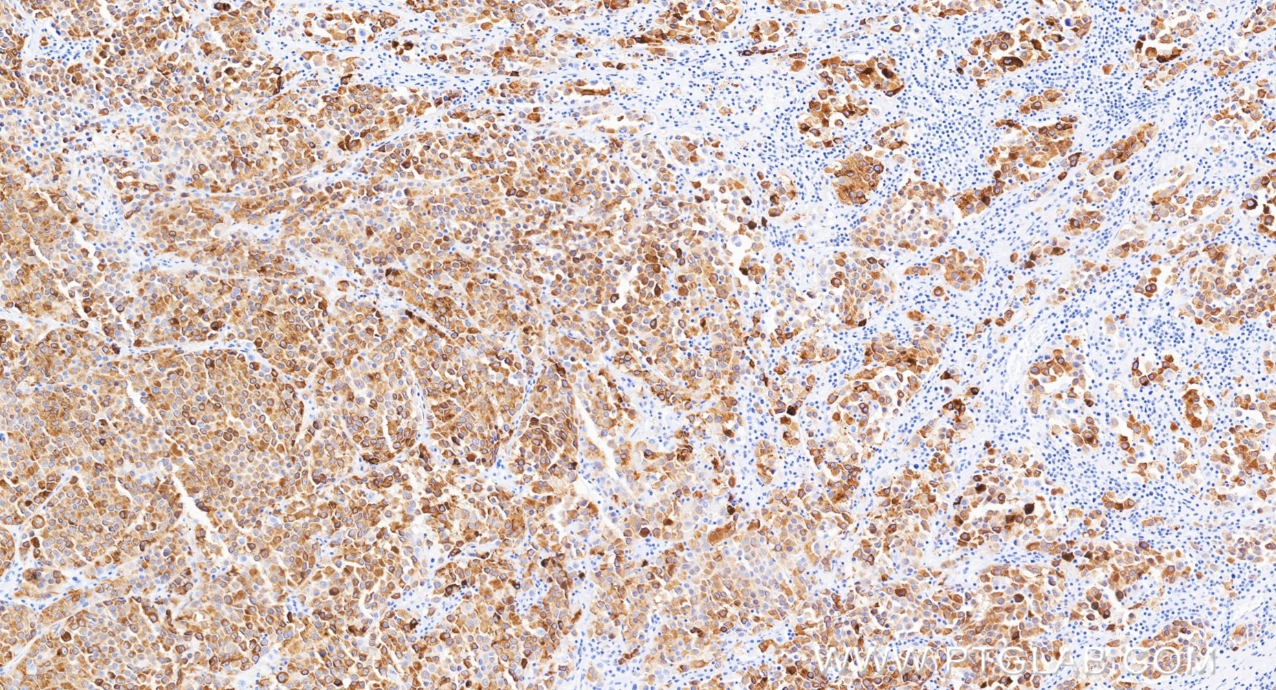 IHC staining of human malignant melanoma using 87351-4-PBS Immunohistochemistry (IHC) staining of human malignant melanoma tissue using Melan-A Recombinant monoclonal antibody, PBS Only (87351-4-PBS)