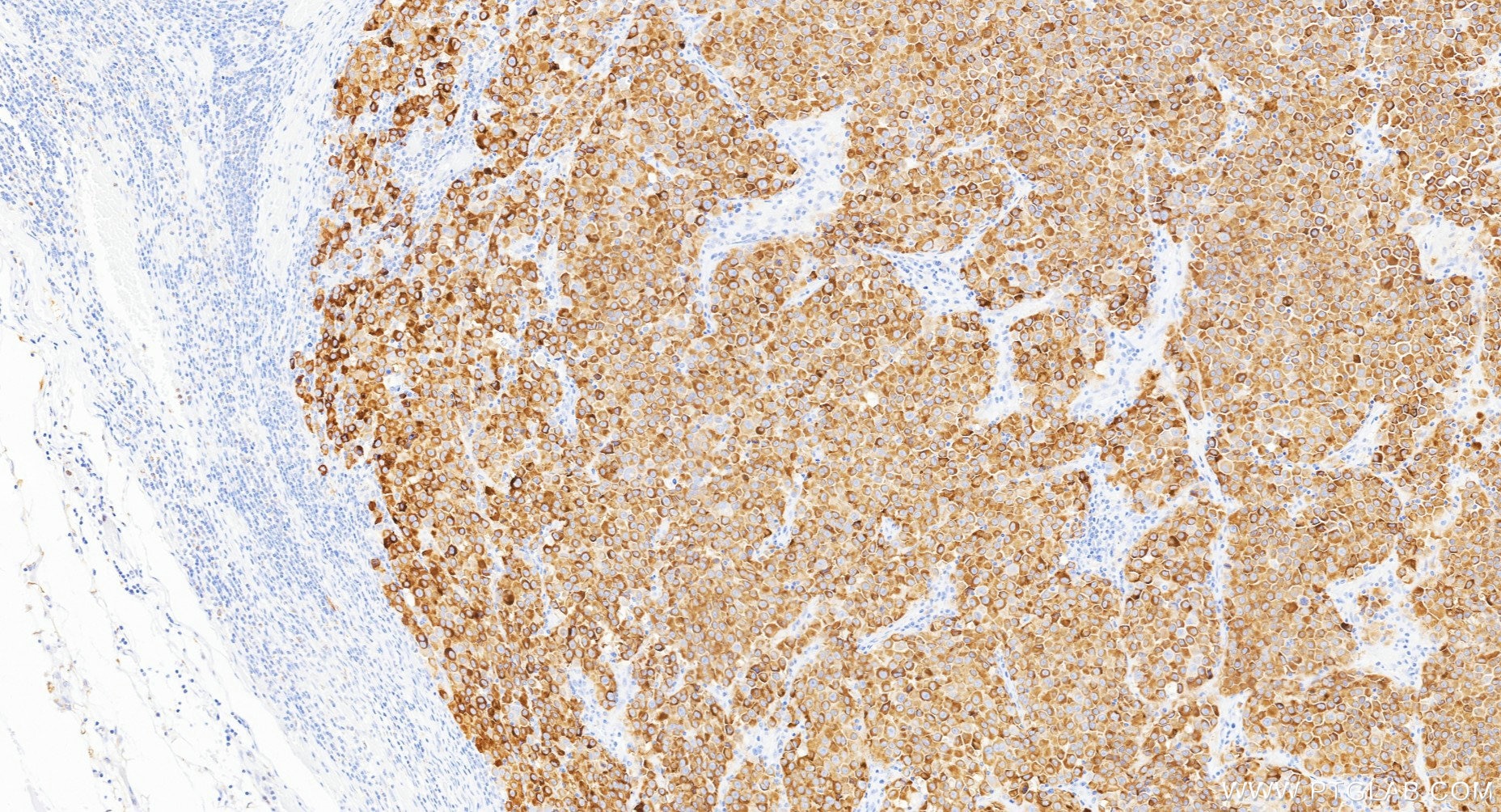 IHC staining of human malignant melanoma using Biotin-87351-4 Immunohistochemistry (IHC) staining of human malignant melanoma tissue using Biotin-conjugated Melan-A Recombinant monoclonal a (Biotin-87351-4)