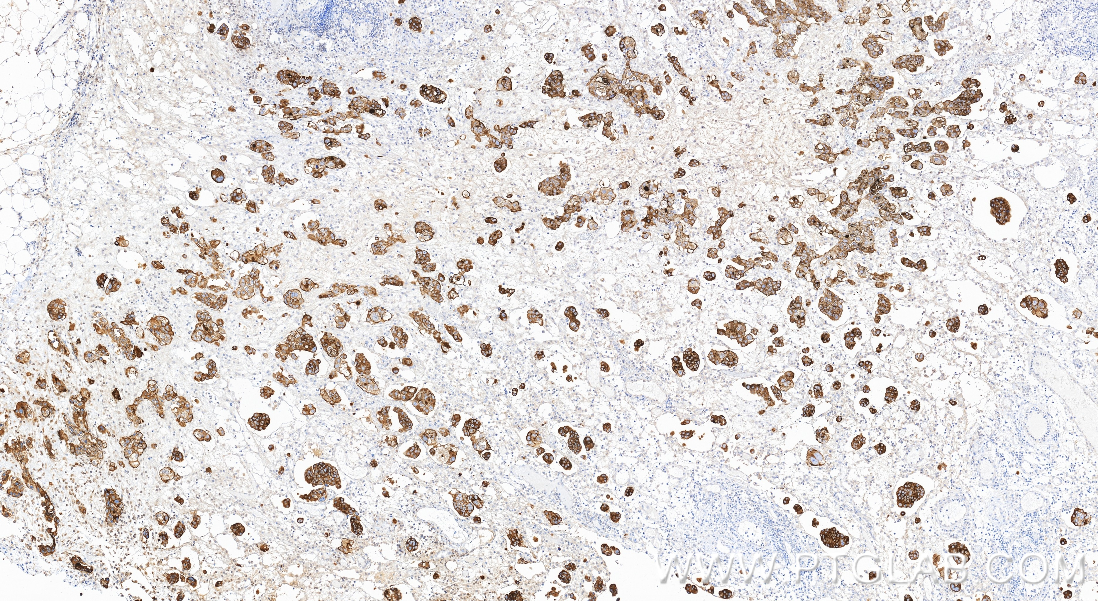 Immunohistochemistry (IHC) staining of human ovary cancer tissue using Anti-Human Mesothelin Rabbit Recombinant Antibody (98776-3-RR)