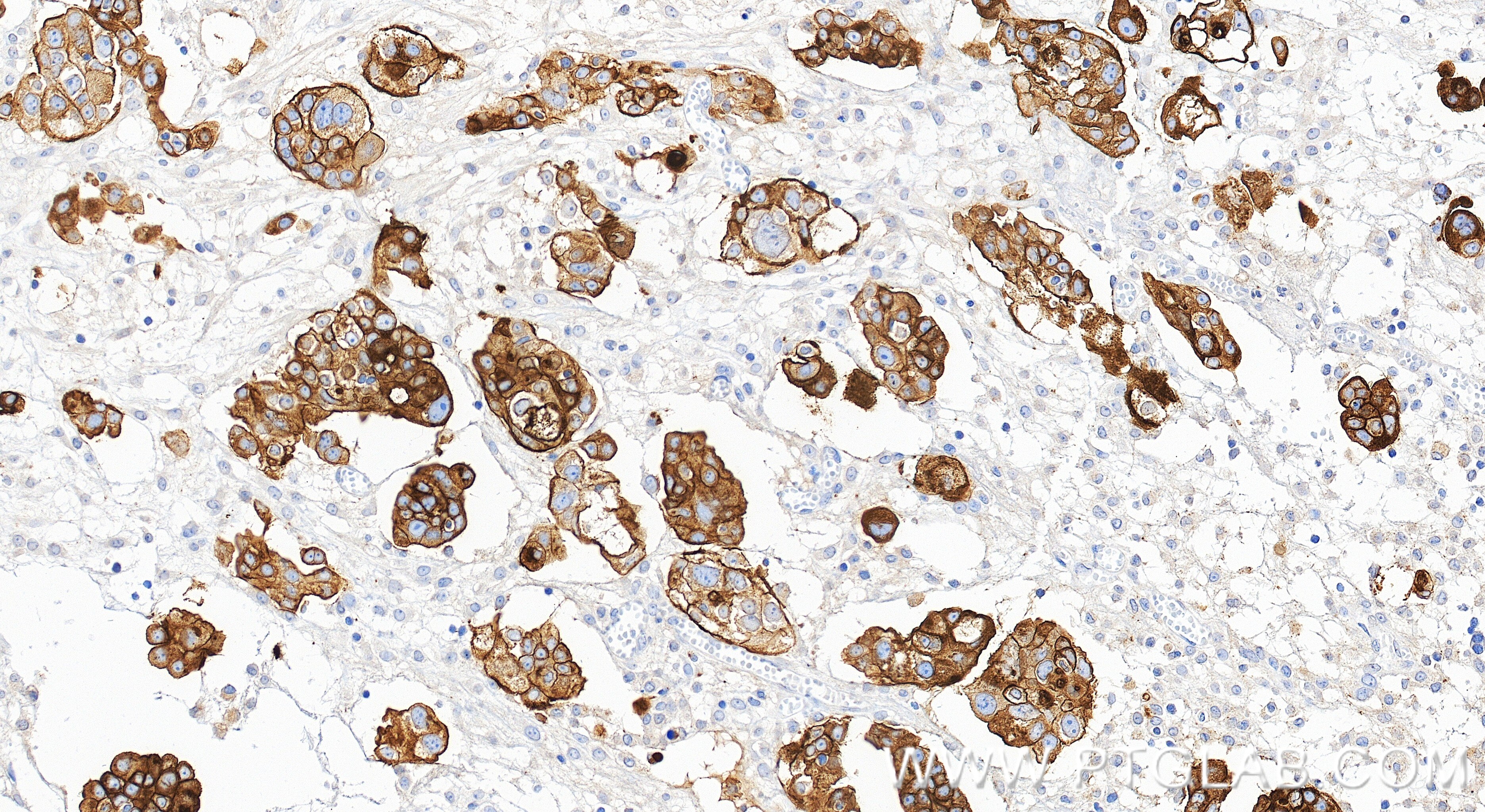 Immunohistochemistry (IHC) staining of human ovary cancer tissue using Anti-Human Mesothelin Rabbit Recombinant Antibody (98776-3-RR)