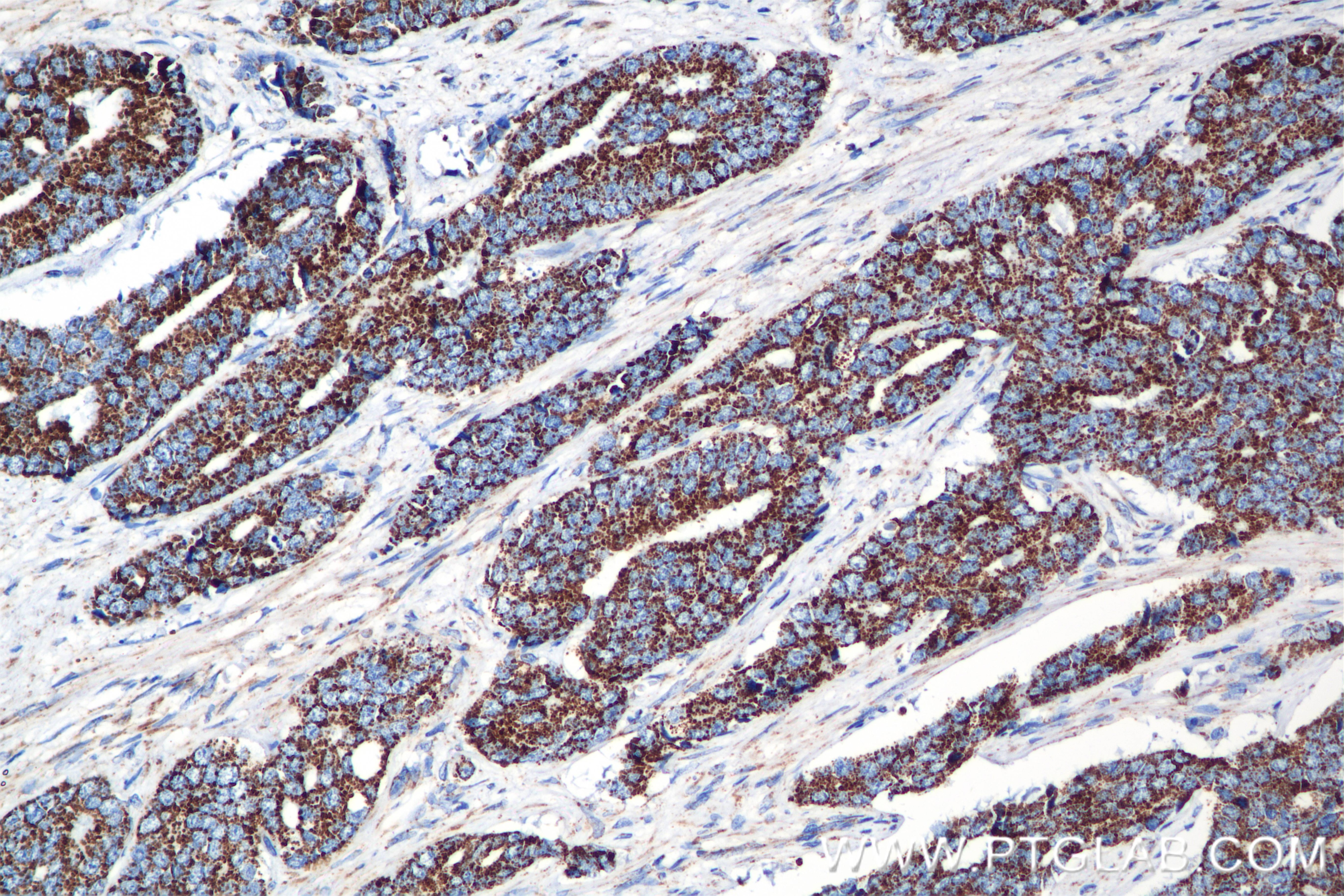 Immunohistochemistry (IHC) staining of human prostate cancer tissue using Methylmalonyl Coenzyme A mutase/MUT Recombinant an (84879-5-RR)