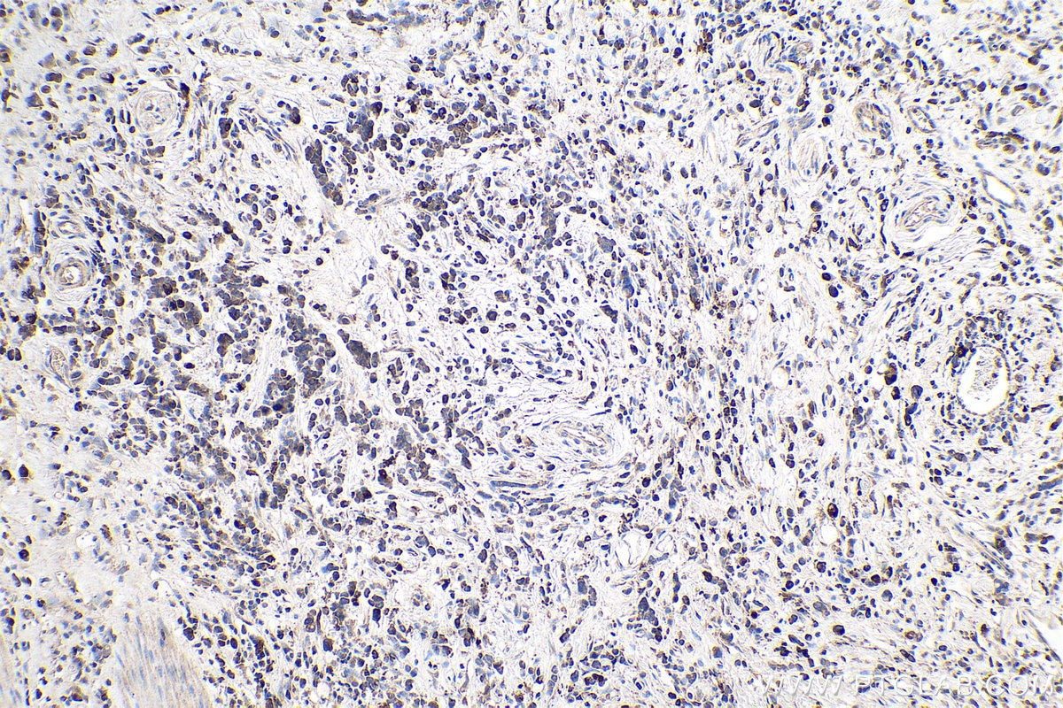 Immunohistochemistry (IHC) staining of human stomach cancer tissue using Midkine Polyclonal antibody (28546-1-AP)