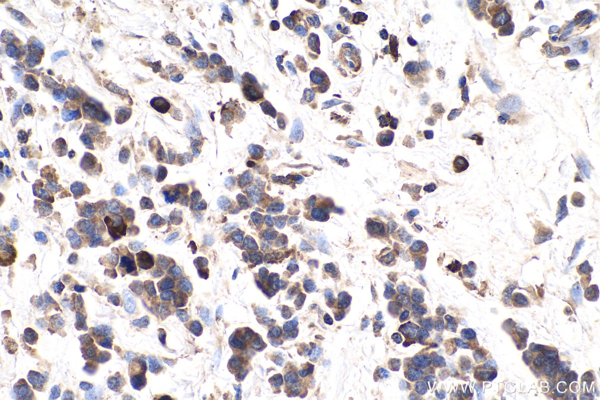 Immunohistochemistry (IHC) staining of human stomach cancer tissue using Midkine Polyclonal antibody (28546-1-AP)