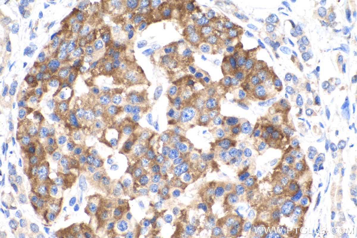 Immunohistochemistry (IHC) staining of human pancreas cancer tissue using Midkine Polyclonal antibody (28546-1-AP)