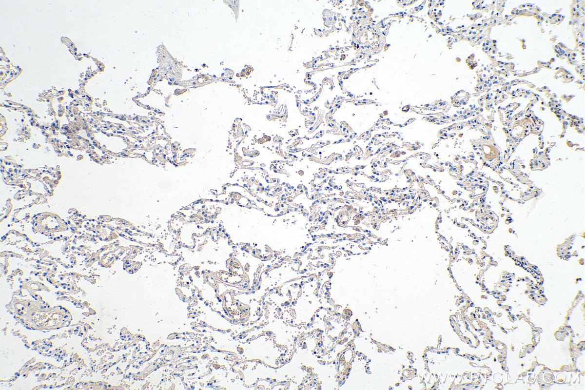 Immunohistochemistry (IHC) staining of human lung cancer tissue using Midkine Polyclonal antibody (28546-1-AP)