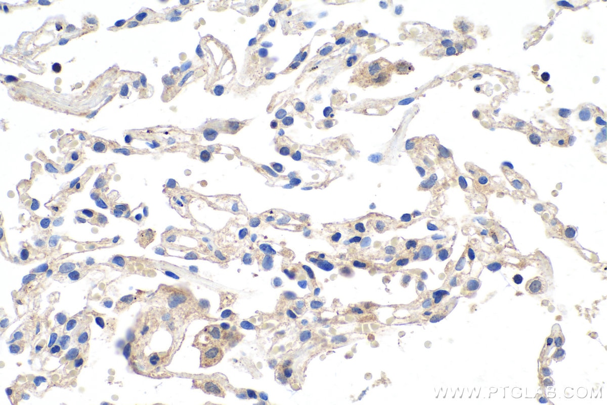 Immunohistochemistry (IHC) staining of human lung cancer tissue using Midkine Polyclonal antibody (28546-1-AP)