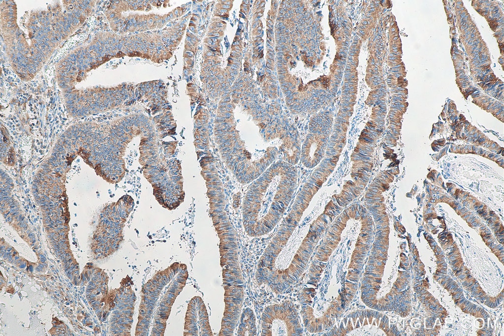 Immunohistochemistry (IHC) staining of human colon cancer tissue using Biotin-conjugated Mouse-IgG Polyclonal antibody (Biotin-10283)