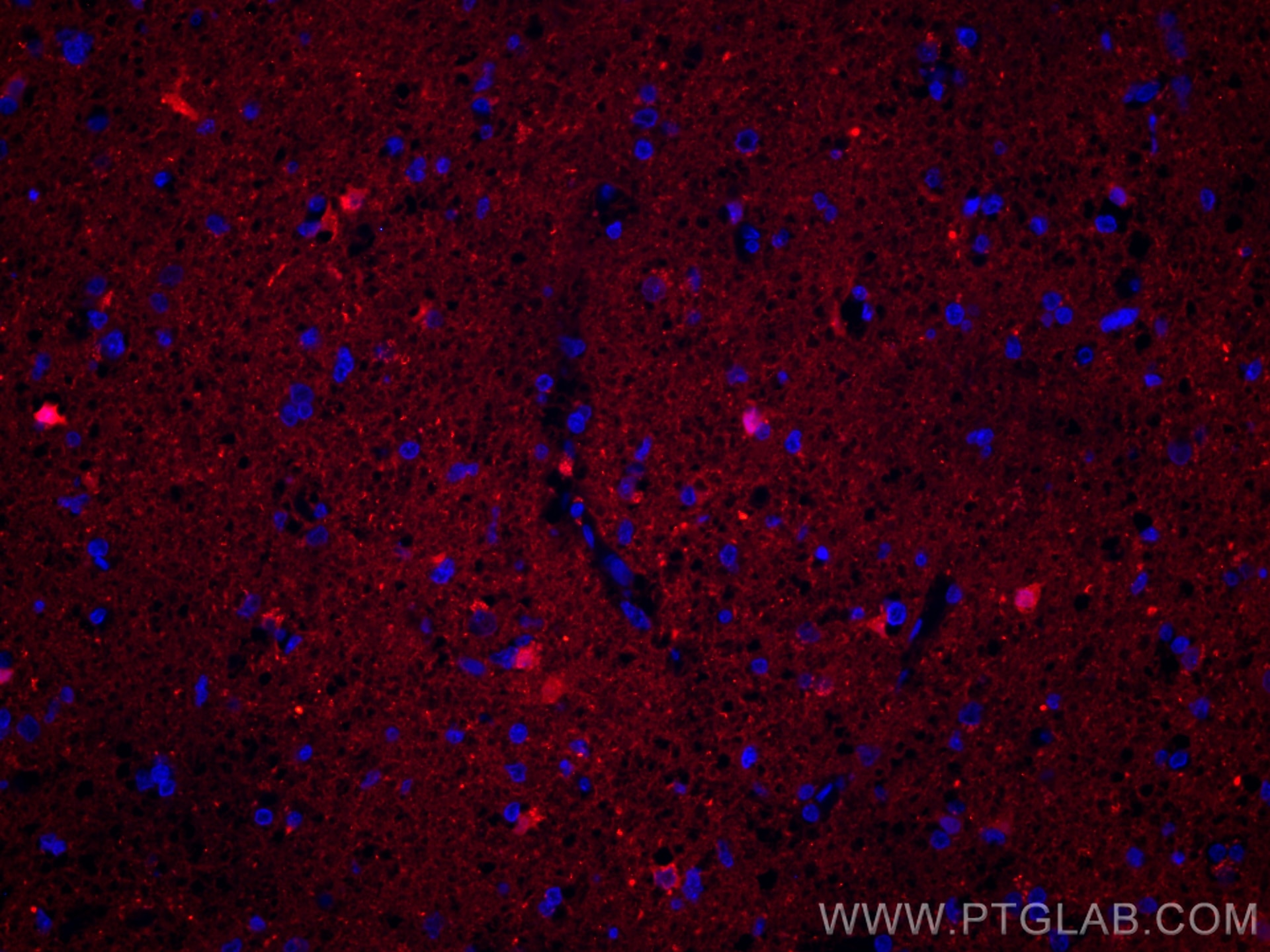 Immunofluorescence (IF) / fluorescent staining of human gliomas tissue using CoraLite®594-conjugated Mu Crystallin Polyclonal a (CL594-12495)