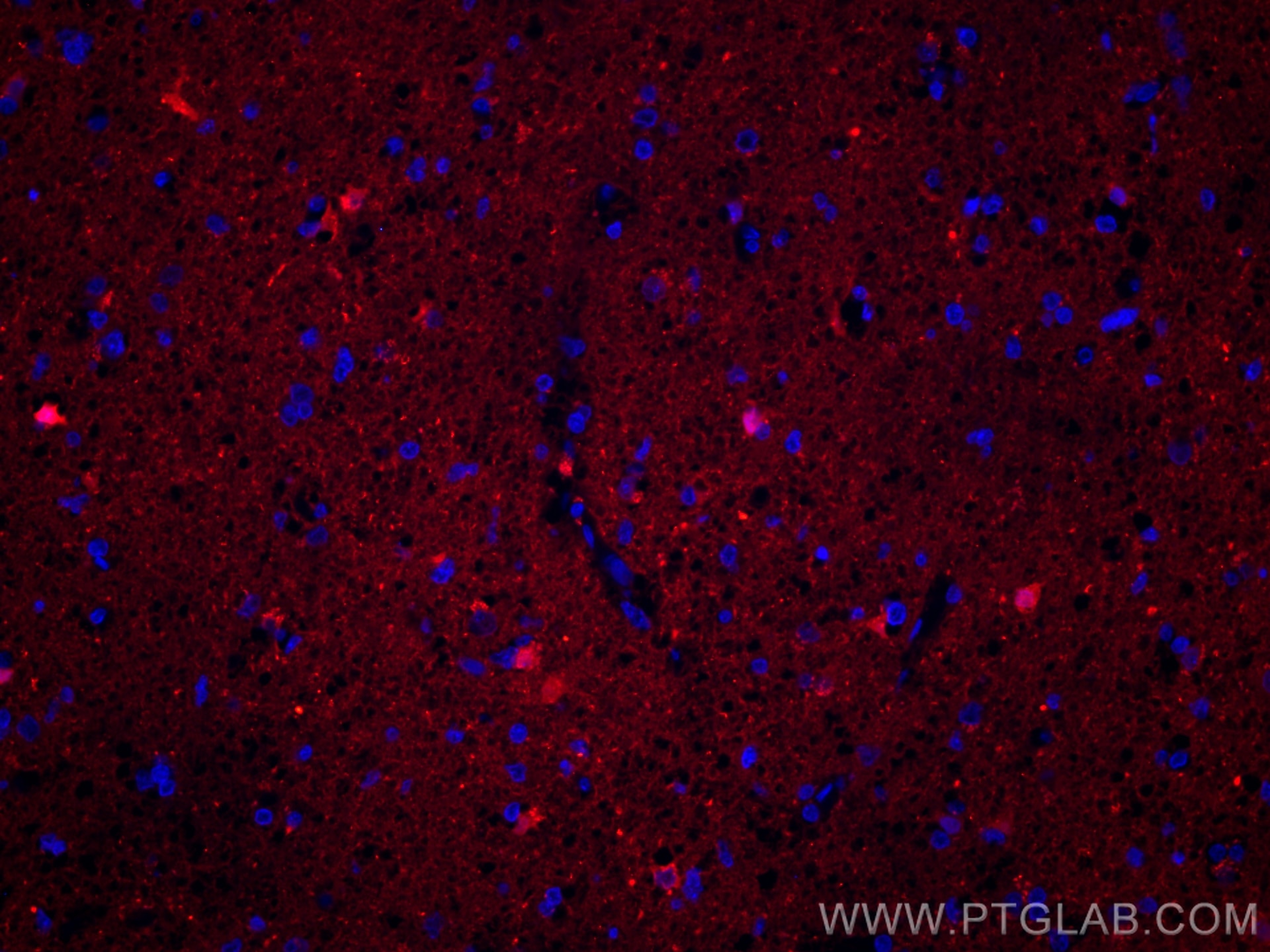 IF Staining of human gliomas using CL594-12495