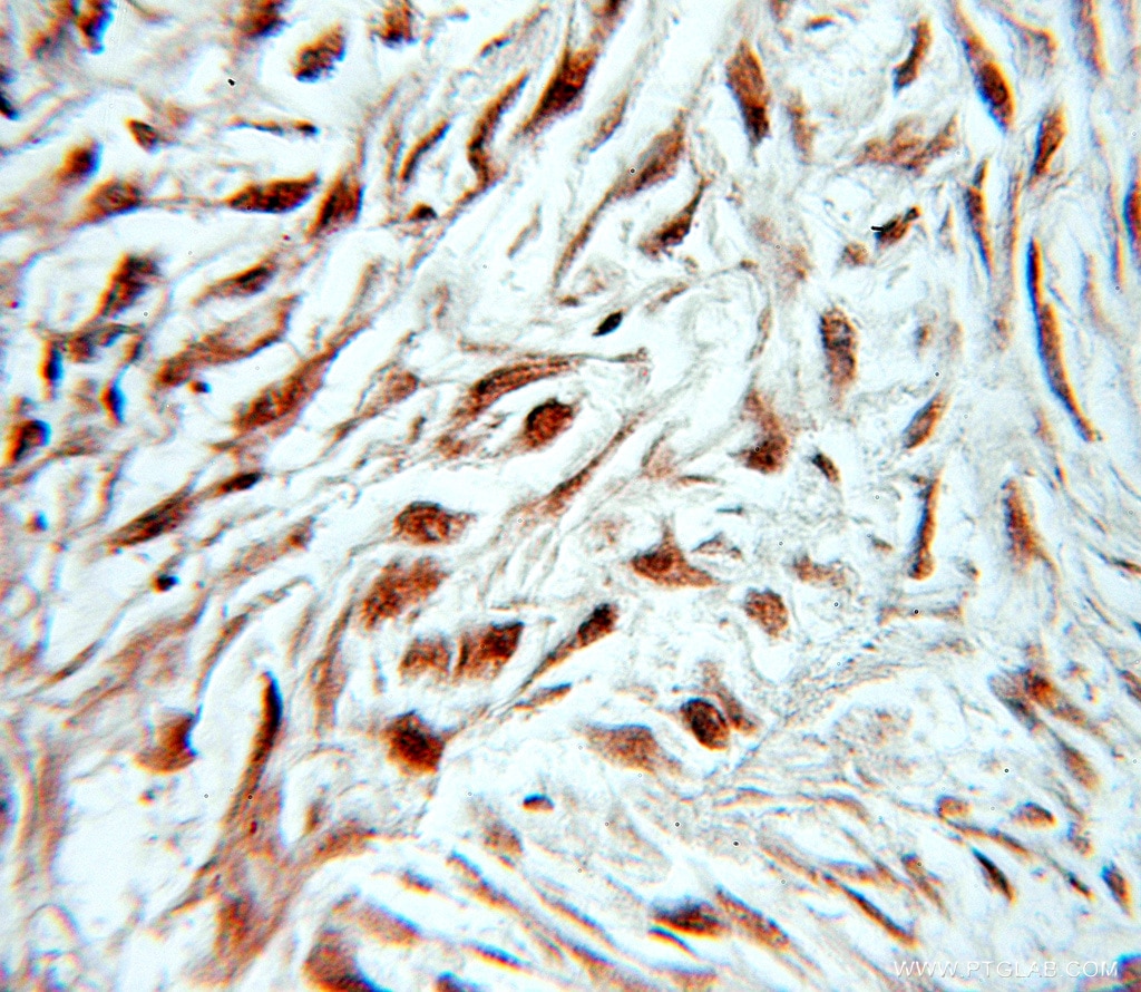 Immunohistochemistry (IHC) staining of human ovary tumor tissue using MSI2 Polyclonal antibody (10770-1-AP)