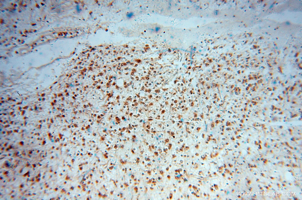 IHC staining of human gliomas using 10770-1-AP
