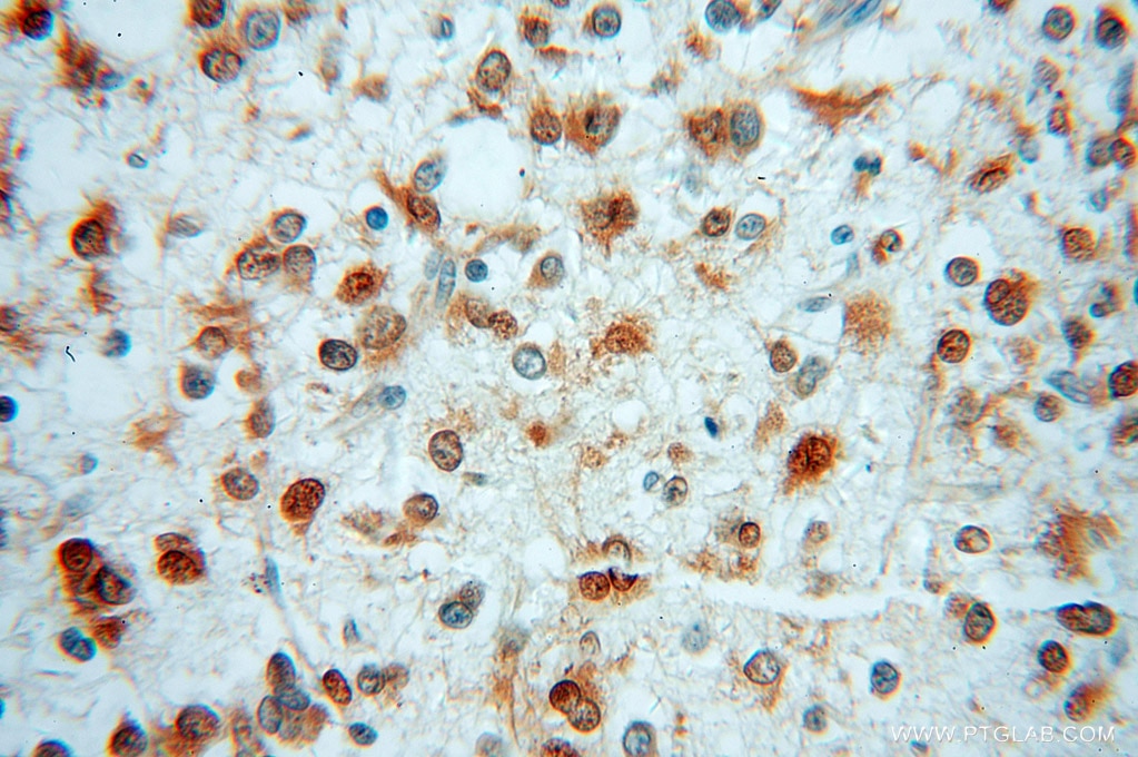 Immunohistochemistry (IHC) staining of human gliomas tissue using MSI2 Polyclonal antibody (10770-1-AP)
