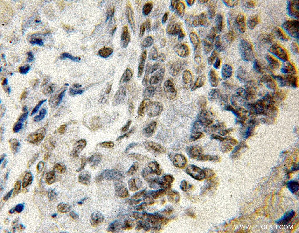 Immunohistochemistry (IHC) staining of human colon cancer tissue using Myocd Polyclonal antibody (12457-1-AP)