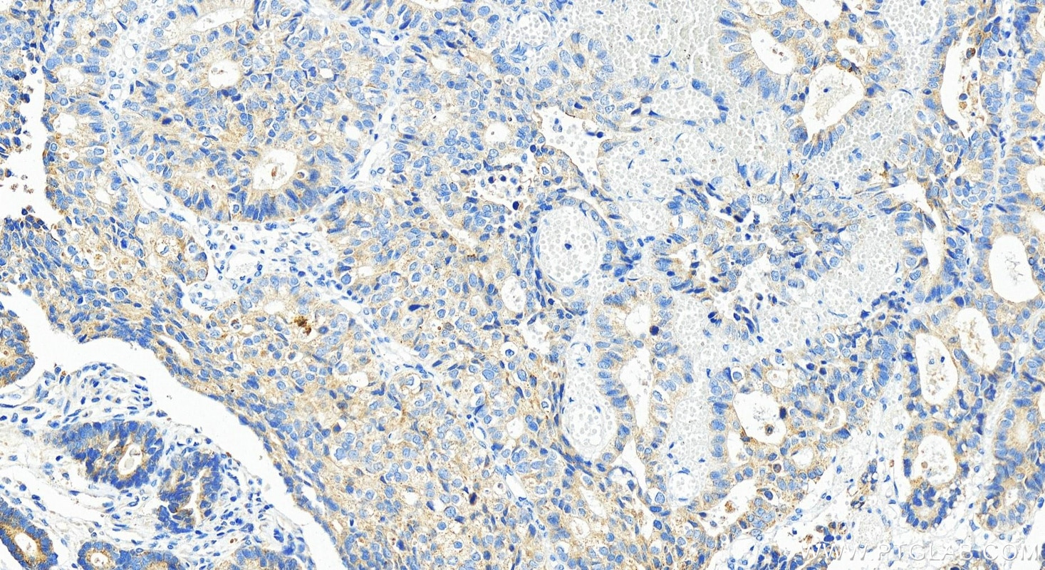 Immunohistochemistry (IHC) staining of human stomach cancer tissue using Myopodin Polyclonal antibody (25453-1-AP)