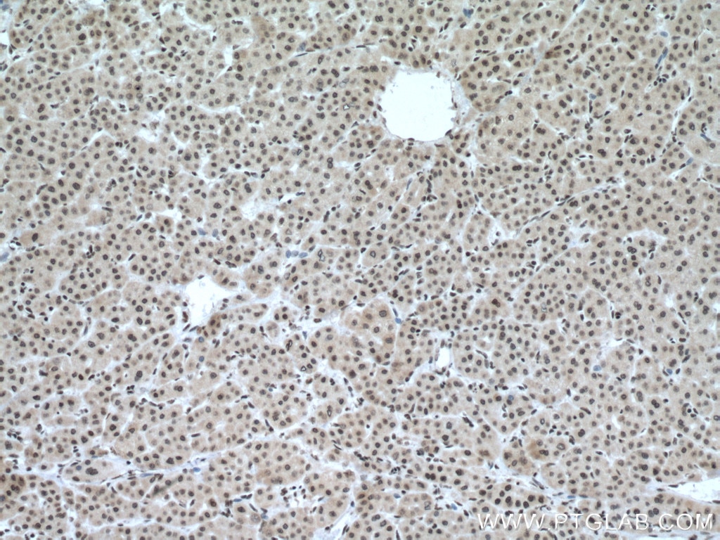 Immunohistochemistry (IHC) staining of human liver cancer tissue using GLYR1 Polyclonal antibody (14833-1-AP)