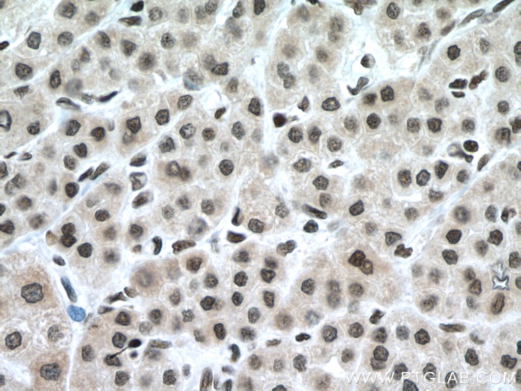 Immunohistochemistry (IHC) staining of human liver cancer tissue using GLYR1 Polyclonal antibody (14833-1-AP)