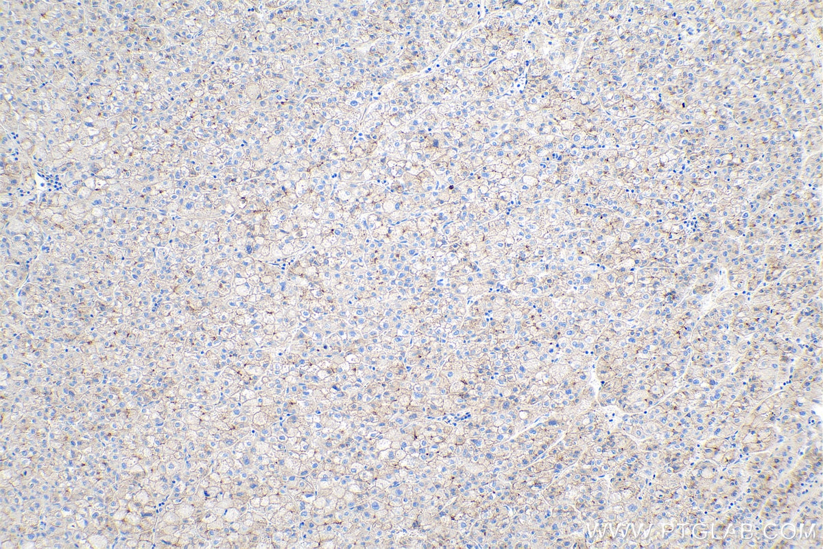 IHC staining of human liver cancer using 66219-1-Ig Immunohistochemistry (IHC) staining of human liver cancer tissue using N-cadherin Monoclonal antibody (66219-1-Ig)