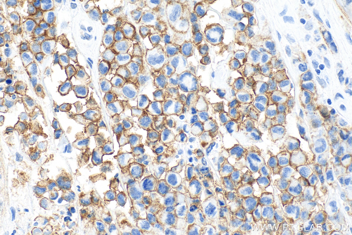 Immunohistochemistry (IHC) staining of human malignant melanoma tissue using N-cadherin Monoclonal antibody (66219-1-Ig)