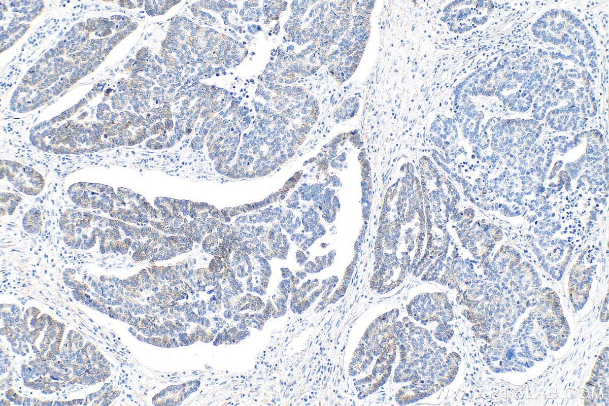 Immunohistochemistry (IHC) staining of human ovary tumor tissue using N-cadherin Monoclonal antibody (66219-1-Ig)