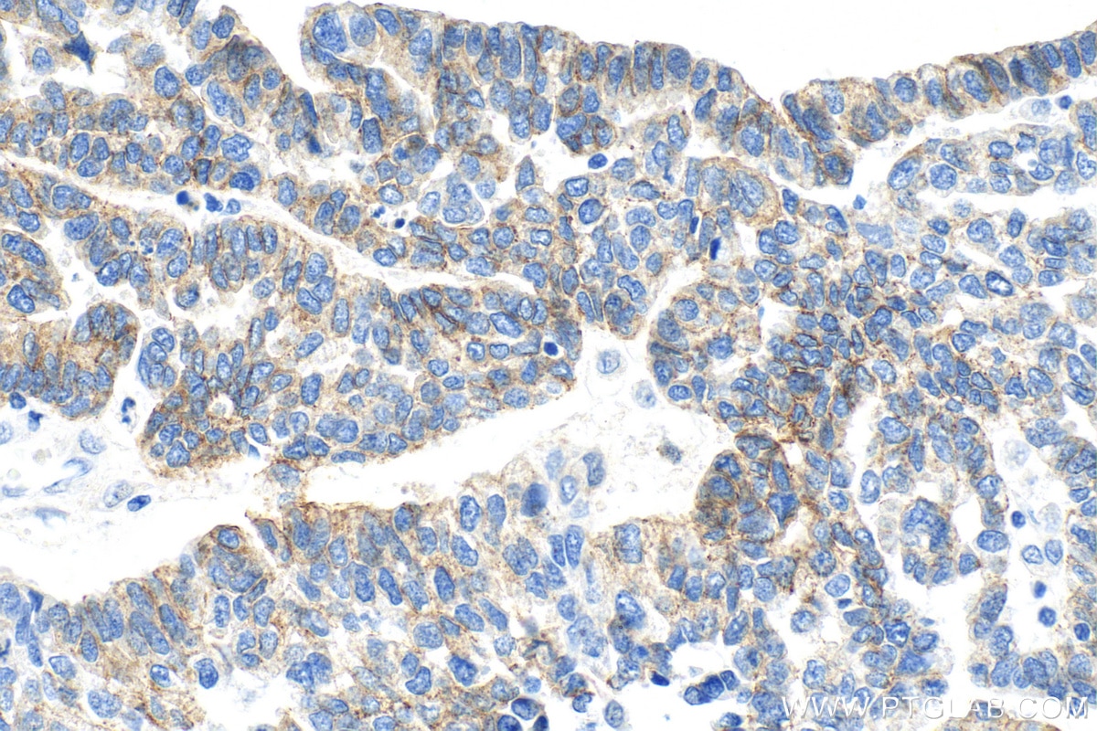 Immunohistochemistry (IHC) staining of human ovary tumor tissue using N-cadherin Monoclonal antibody (66219-1-Ig)