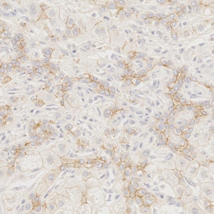 IHC staining of human liver using 66219-1-Ig Immunohistochemistry (IHC) staining of human liver tissue using N-cadherin Monoclonal antibody (66219-1-Ig)