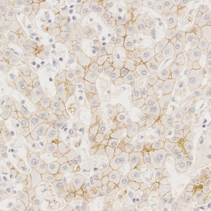 IHC staining of Cholangiocarcinoma using 66219-1-Ig Immunohistochemistry (IHC) staining of Cholangiocarcinoma tissue using N-cadherin Monoclonal antibody (66219-1-Ig)