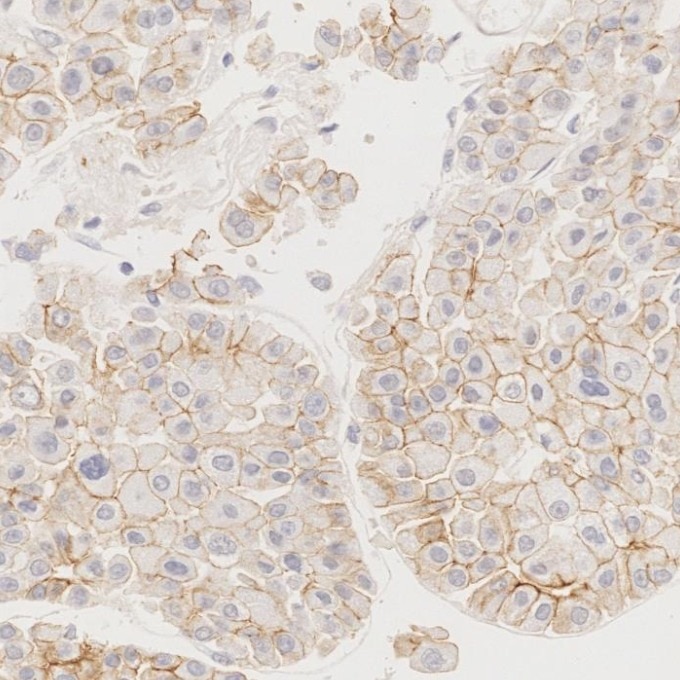IHC staining of human liver cancer using 66219-1-Ig Immunohistochemistry (IHC) staining of human liver cancer tissue using N-cadherin Monoclonal antibody (66219-1-Ig)