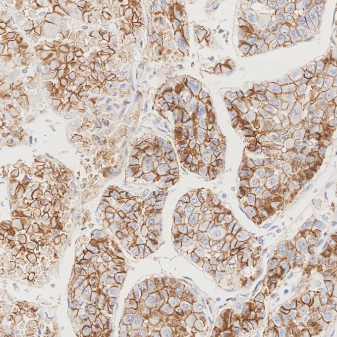 Immunohistochemistry (IHC) staining of human liver cancer tissue using N-cadherin Recombinant monoclonal antibody (82968-1-RR)