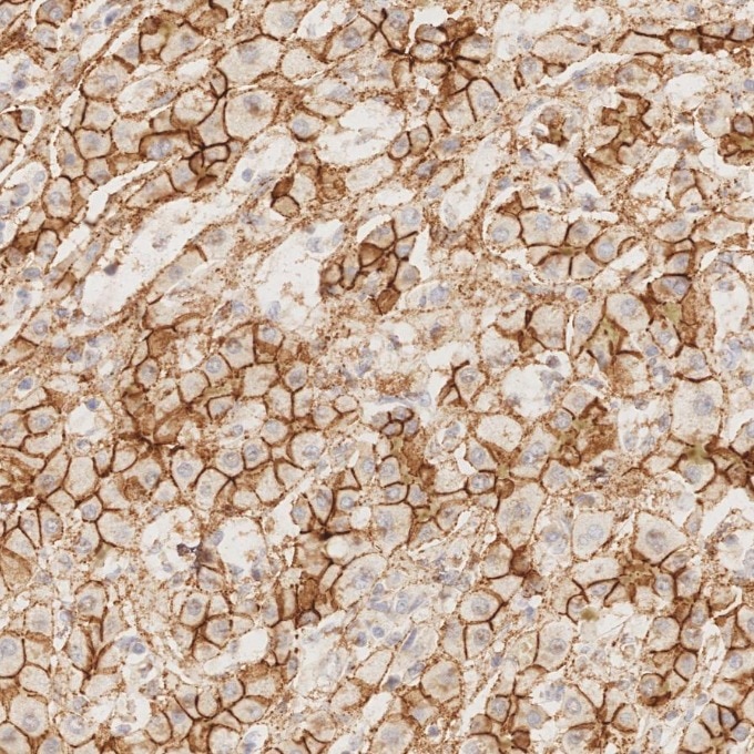Immunohistochemistry (IHC) staining of Cholangiocarcinoma tissue using N-cadherin Recombinant monoclonal antibody (82968-1-RR)