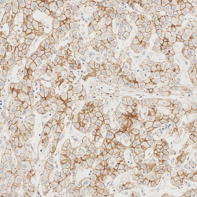 Immunohistochemistry (IHC) staining of Cholangiocarcinoma tissue using N-cadherin Recombinant monoclonal antibody (82968-1-RR)