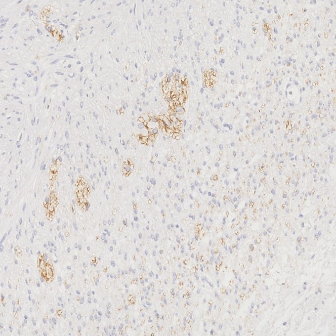 Immunohistochemistry (IHC) staining of human appendicitis tissue using N-cadherin Recombinant monoclonal antibody (82968-1-RR)