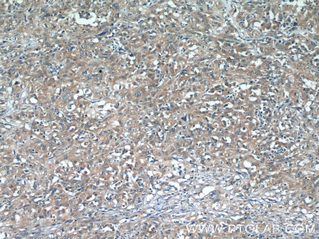 Immunohistochemistry (IHC) staining of human cervical cancer tissue using N4BP3 Polyclonal antibody (16733-1-AP)