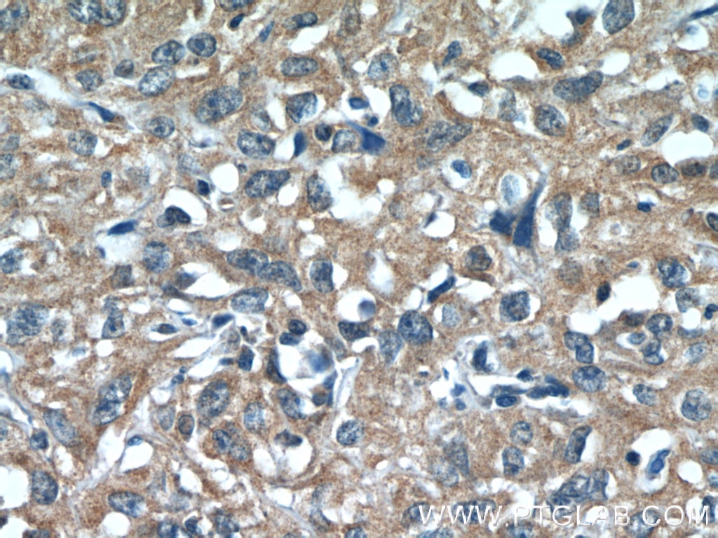 Immunohistochemistry (IHC) staining of human cervical cancer tissue using N4BP3 Polyclonal antibody (16733-1-AP)
