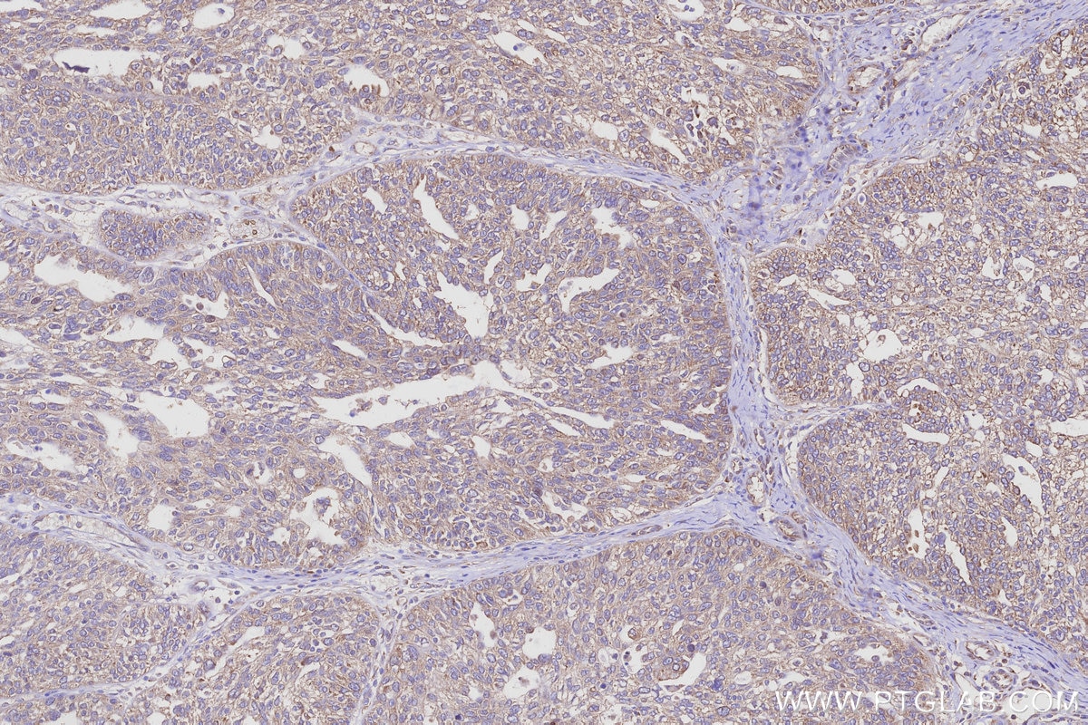 IHC staining of human ovary cancer using 32235-1-AP Immunohistochemistry (IHC) staining of human ovary cancer tissue using NACA Polyclonal antibody (32235-1-AP)