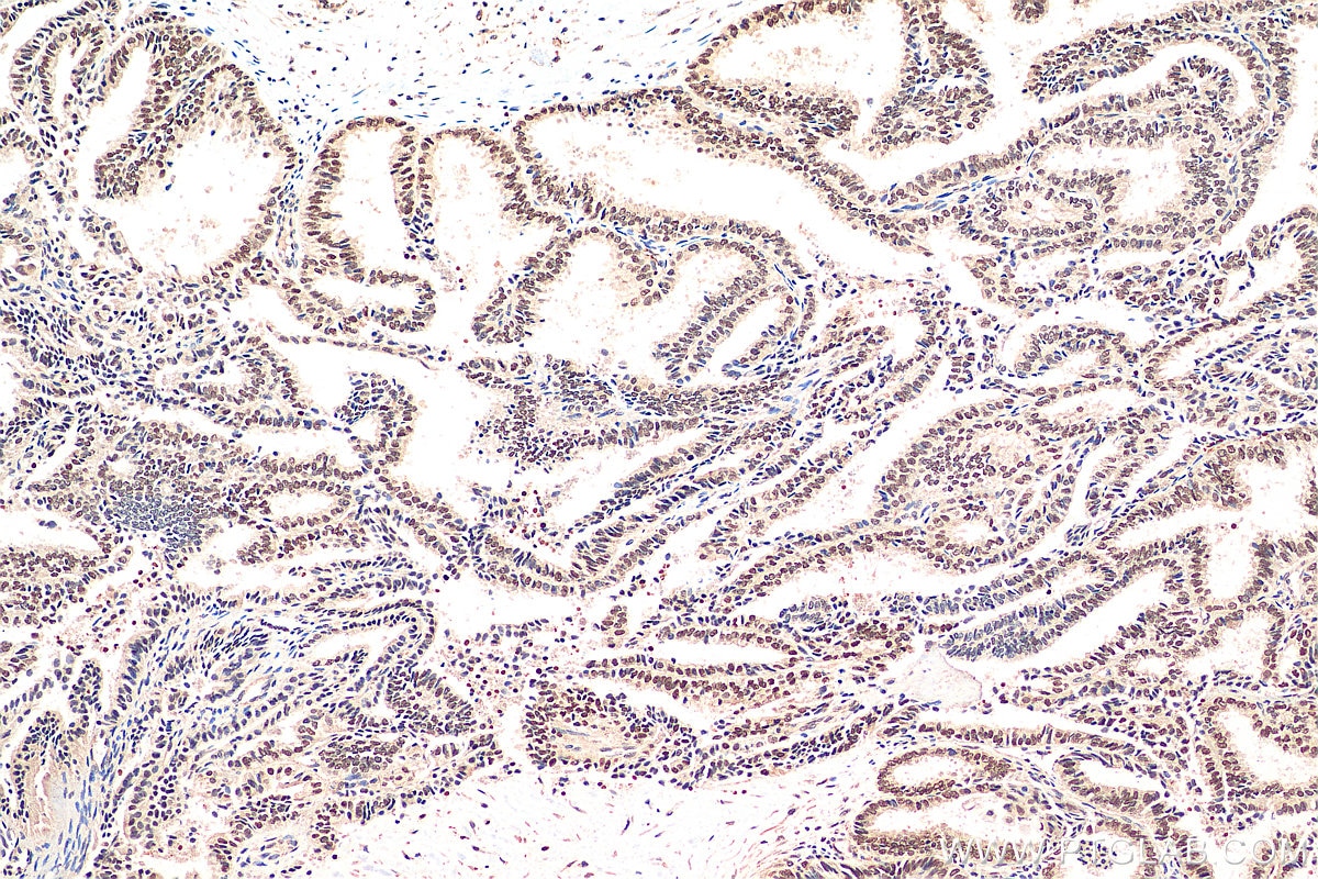 Immunohistochemistry (IHC) staining of human ovary tumor tissue using NACC1 Polyclonal antibody (14551-1-AP)