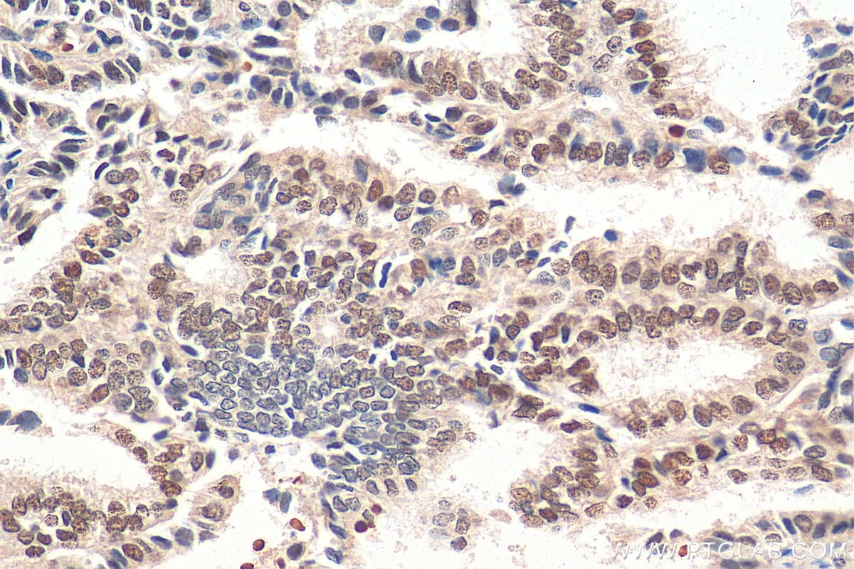 Immunohistochemistry (IHC) staining of human ovary tumor tissue using NACC1 Polyclonal antibody (14551-1-AP)