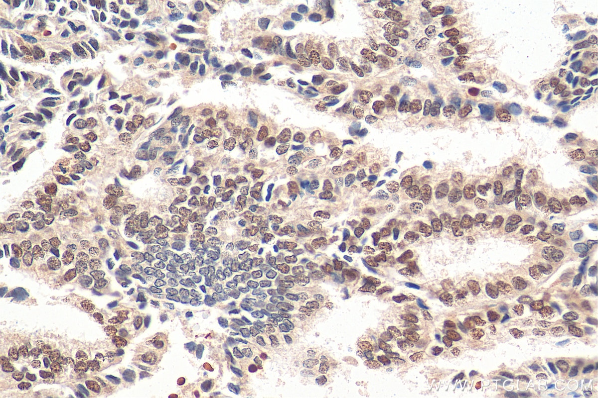 IHC staining of human ovary tumor using 14551-1-AP