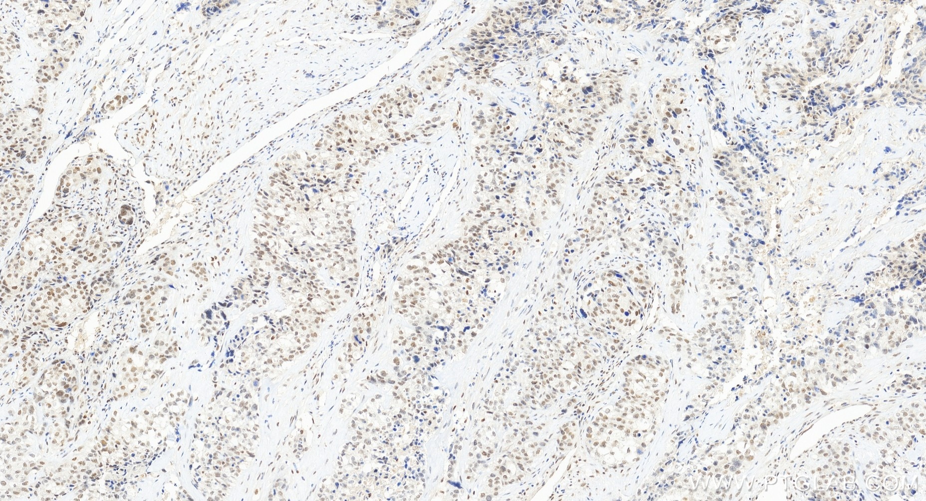 Immunohistochemical analysis of paraffin-embedded human ovary cancer tissue slide using 85380-2-RR (NAC1 antibody) at dilution of 1:200 (under 20x lens). Heat mediated antigen retrieval with Tris-EDTA buffer (pH 9.0). Immunohistochemistry (IHC) staining of human ovary cancer tissue using NAC1 Recombinant monoclonal antibody (85380-2-RR)