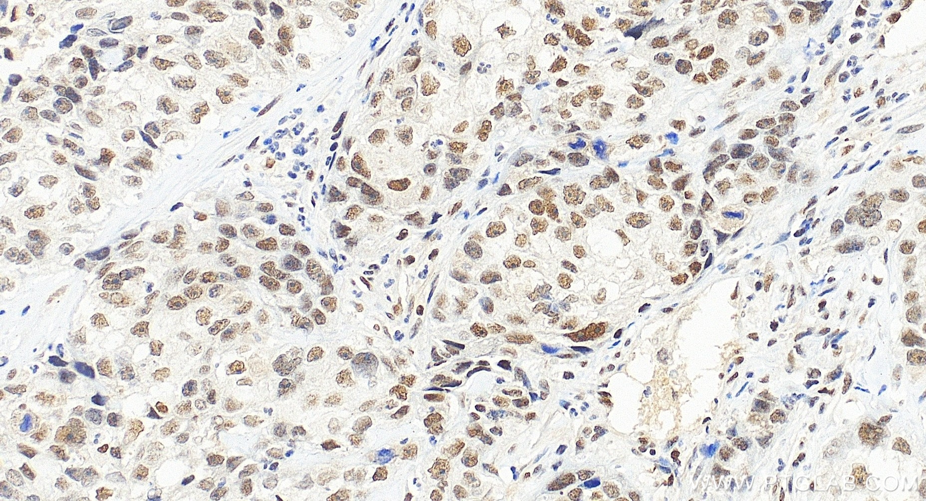 Immunohistochemical analysis of paraffin-embedded human ovary cancer tissue slide using 85380-2-RR (NAC1 antibody) at dilution of 1:200 (under 20x lens). Heat mediated antigen retrieval with Tris-EDTA buffer (pH 9.0). Immunohistochemistry (IHC) staining of human ovary cancer tissue using NAC1 Recombinant monoclonal antibody (85380-2-RR)