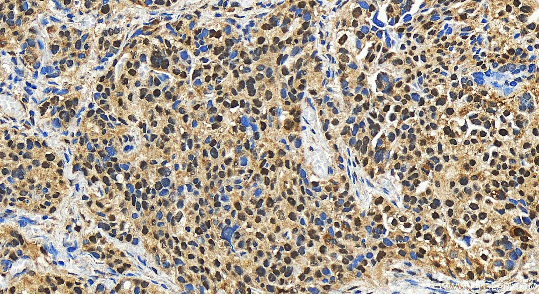 Immunohistochemistry (IHC) staining of human ovary cancer tissue using NAF1 Polyclonal antibody (27764-1-AP)