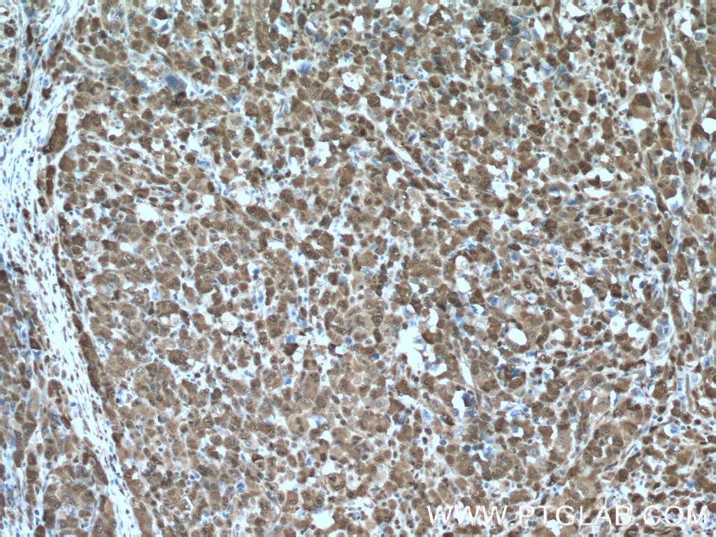 Immunohistochemistry (IHC) staining of human lymphoma tissue using NAMPT/PBEF Polyclonal antibody (11776-1-AP)